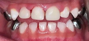 After: Anterior open bite front teeth not touching for up to a week is normal
